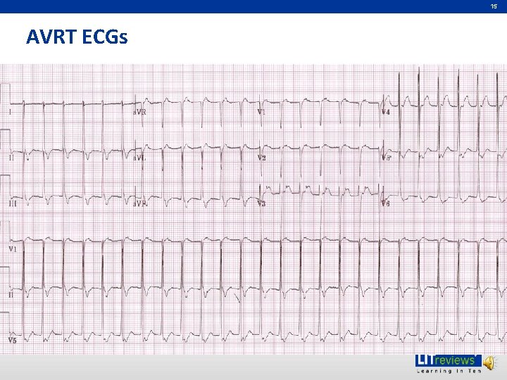 15 AVRT ECGs 