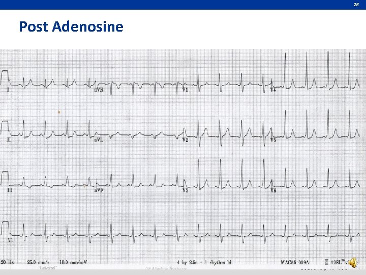 25 Post Adenosine 
