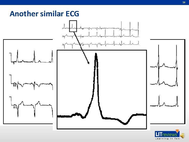 26 Another similar ECG 