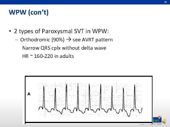 28 WPW (con’t) • 2 types of Paroxysmal SVT in WPW: – Orthodromic (90%)