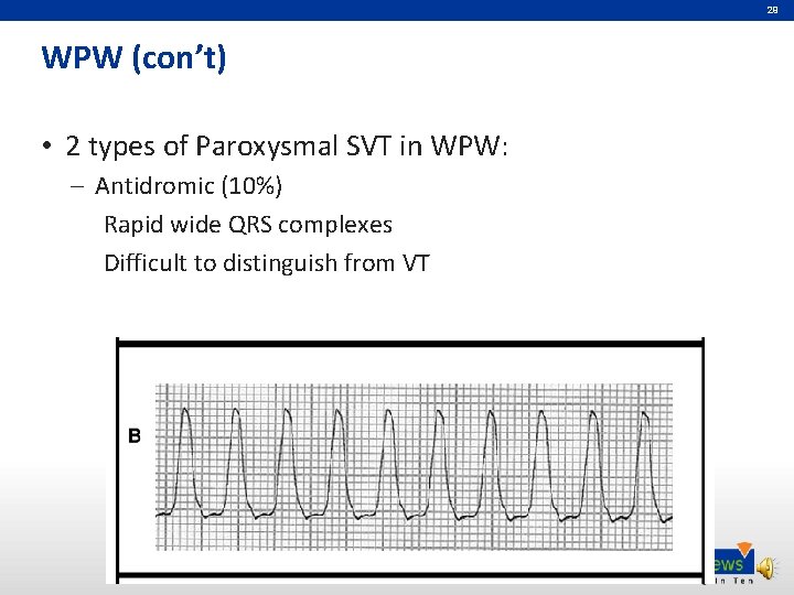 29 WPW (con’t) • 2 types of Paroxysmal SVT in WPW: – Antidromic (10%)