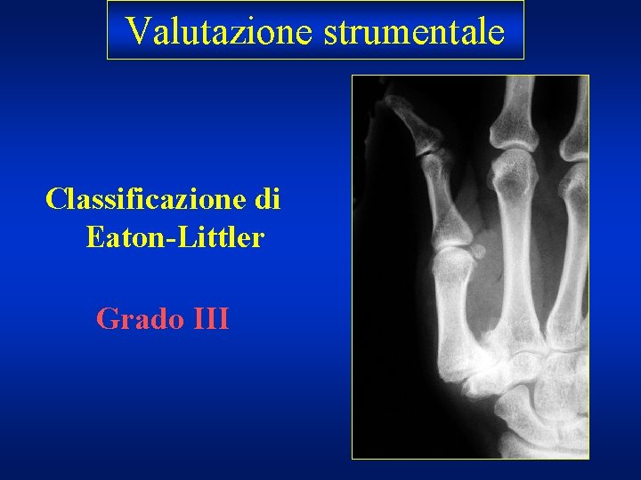 Valutazionestrumentale Classificazione di Eaton-Littler Grado III 