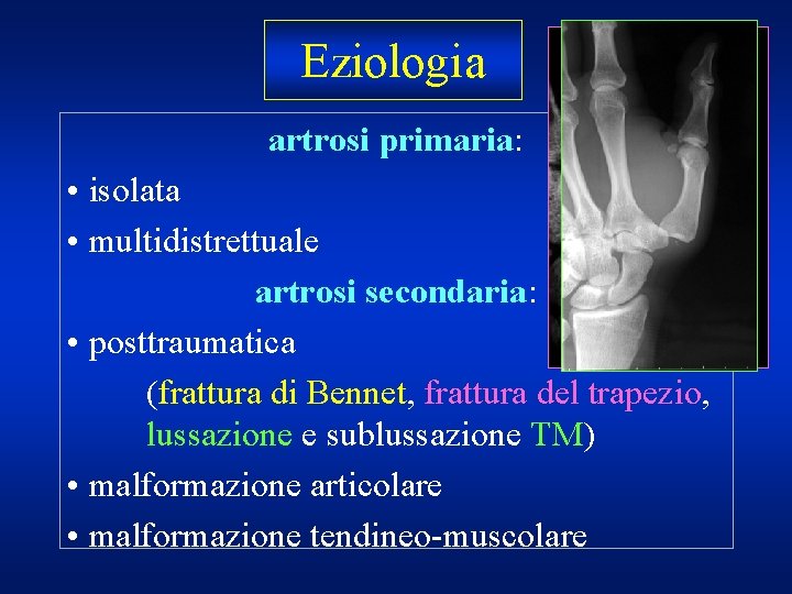 Eziologia artrosi primaria: • isolata • multidistrettuale artrosi secondaria: • posttraumatica (frattura di Bennet,