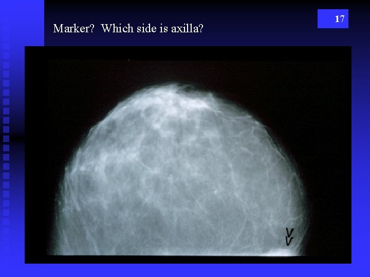 Marker? Which side is axilla? 17 
