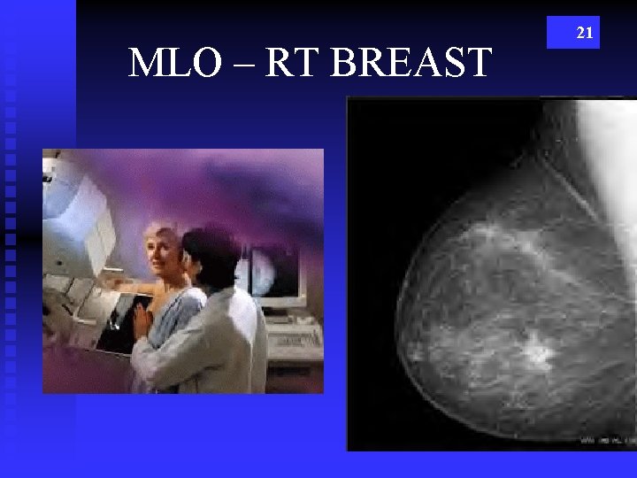 MLO – RT BREAST 21 