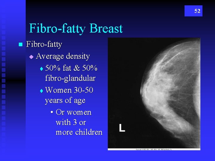 52 Fibro-fatty Breast n Fibro-fatty u Average density t 50% fat & 50% fibro-glandular