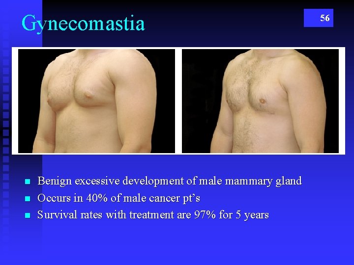 Gynecomastia n n n Benign excessive development of male mammary gland Occurs in 40%