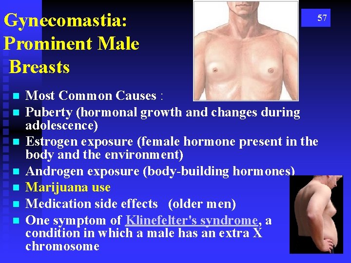 Gynecomastia: Prominent Male Breasts n n n n 57 Most Common Causes : Puberty