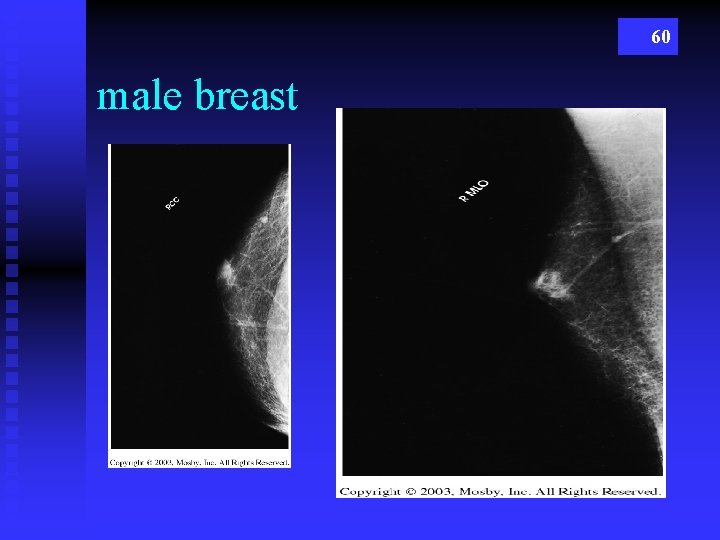 60 male breast 