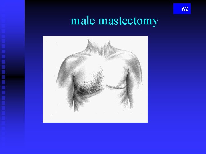 62 male mastectomy 