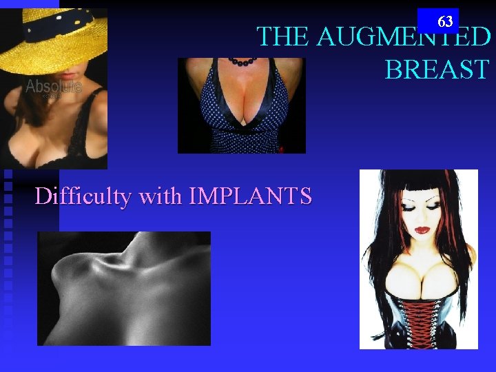 63 THE AUGMENTED BREAST Difficulty with IMPLANTS 