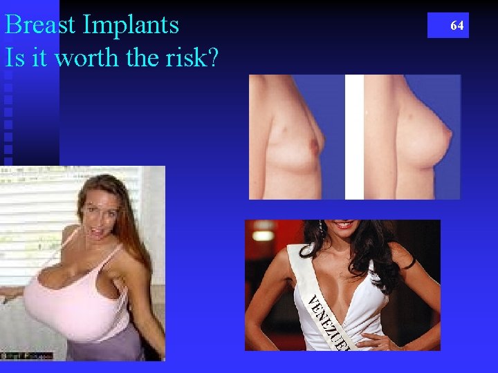 Breast Implants Is it worth the risk? 64 