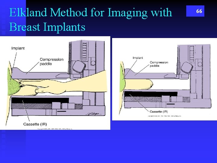 Elkland Method for Imaging with Breast Implants 66 