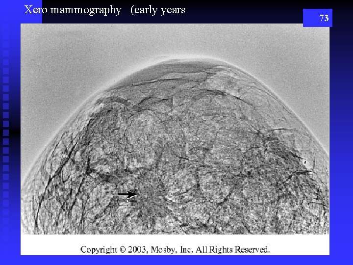 Xero mammography (early years 73 