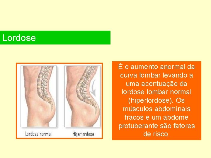 Lordose É o aumento anormal da curva lombar levando a uma acentuação da lordose
