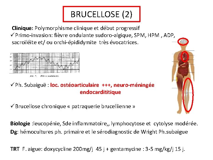 BRUCELLOSE (2) Clinique: Polymorphisme clinique et début progressif üPrimo-invasion: fièvre ondulante sudoro-algique, SPM, HPM