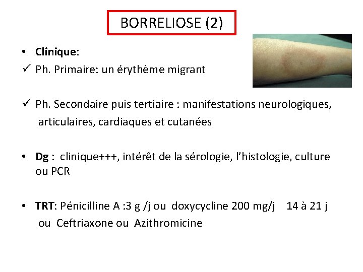 BORRELIOSE (2) • Clinique: ü Ph. Primaire: un érythème migrant ü Ph. Secondaire puis