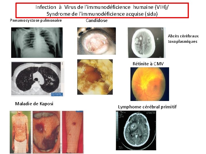 Infection à Virus de l’immunodéficience humaine (VIH)/ Syndrome de l’immunodéficience acquise (sida) Pneumocystose pulmonaire