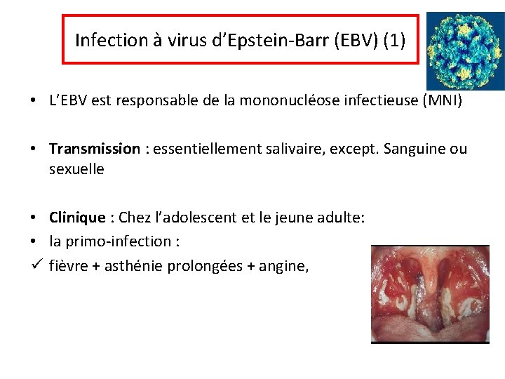 Infection à virus d’Epstein-Barr (EBV) (1) • L’EBV est responsable de la mononucléose infectieuse
