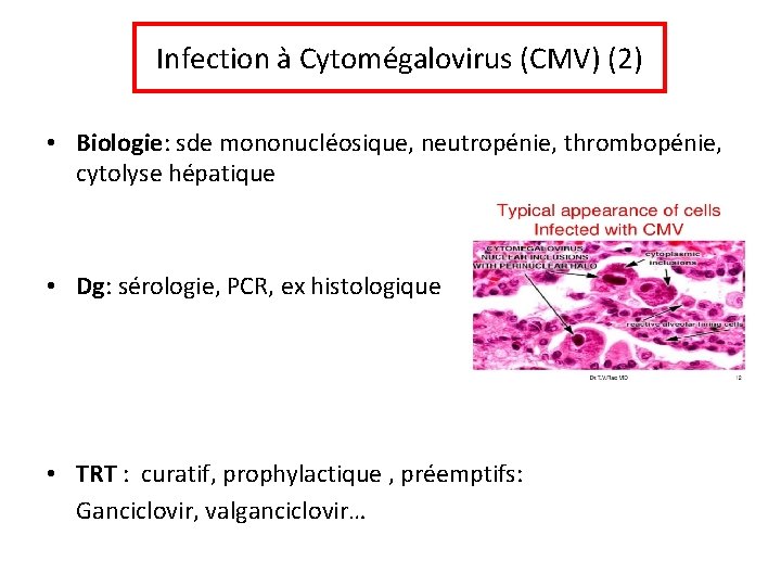 Infection à Cytomégalovirus (CMV) (2) • Biologie: sde mononucléosique, neutropénie, thrombopénie, cytolyse hépatique •