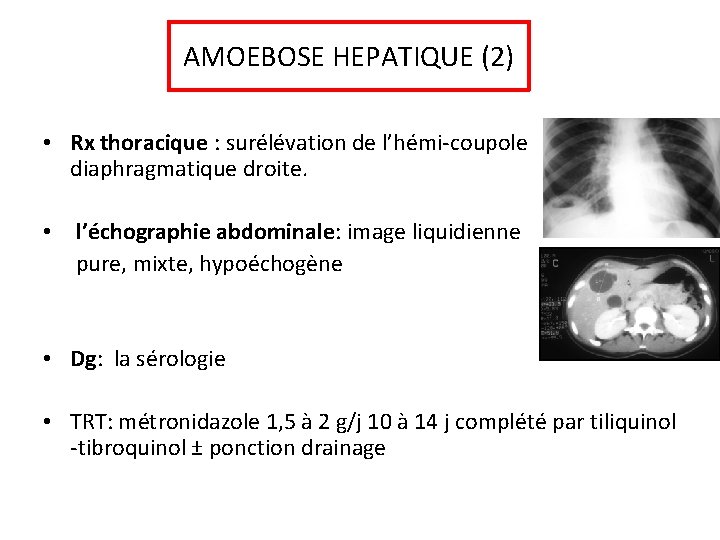 AMOEBOSE HEPATIQUE (2) • Rx thoracique : surélévation de l’hémi-coupole diaphragmatique droite. • l’échographie