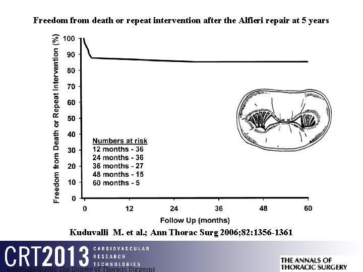 Freedom from death or repeat intervention after the Alfieri repair at 5 years Kuduvalli