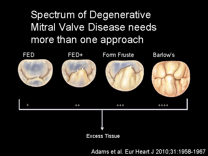 Spectrum of Degenerative Mitral Valve Disease needs more than one approach FED + FED+