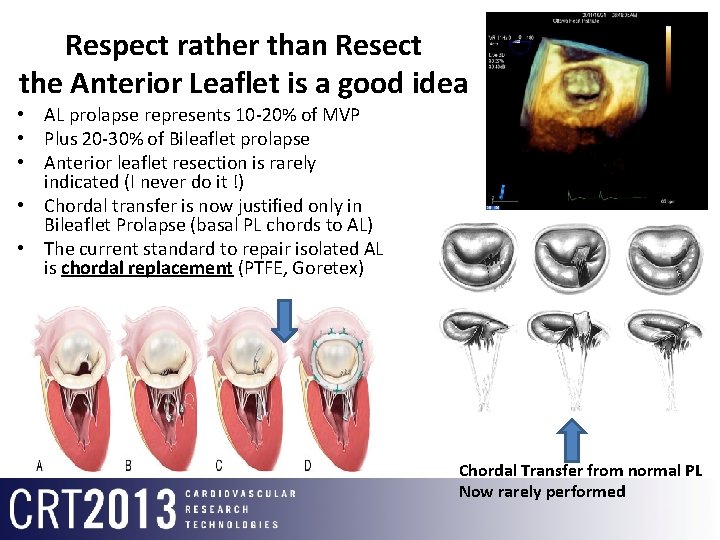 Respect rather than Resect the Anterior Leaflet is a good idea • AL prolapse