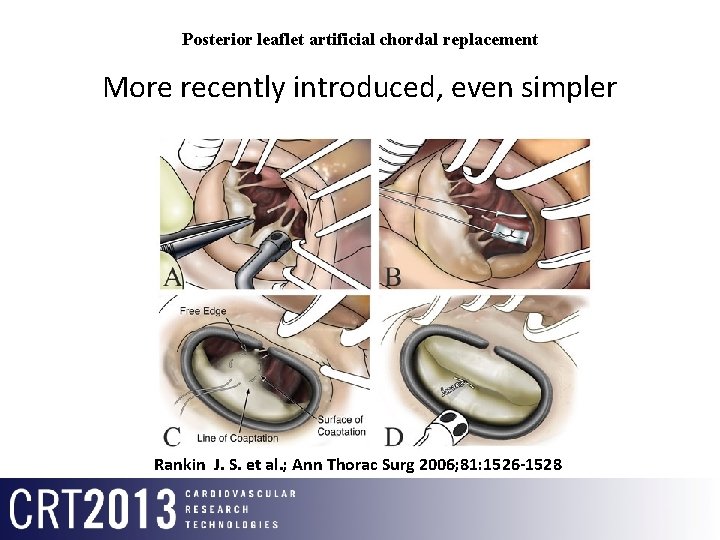 Posterior leaflet artificial chordal replacement More recently introduced, even simpler Rankin J. S. et