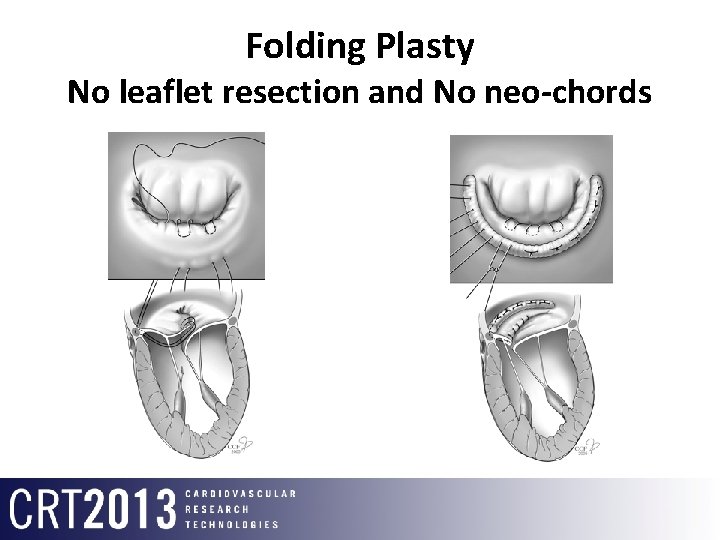 Folding Plasty No leaflet resection and No neo-chords 