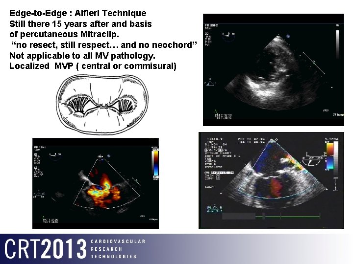 Edge-to-Edge : Alfieri Technique Still there 15 years after and basis of percutaneous Mitraclip.