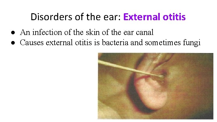 Disorders of the ear: External otitis ● An infection of the skin of the