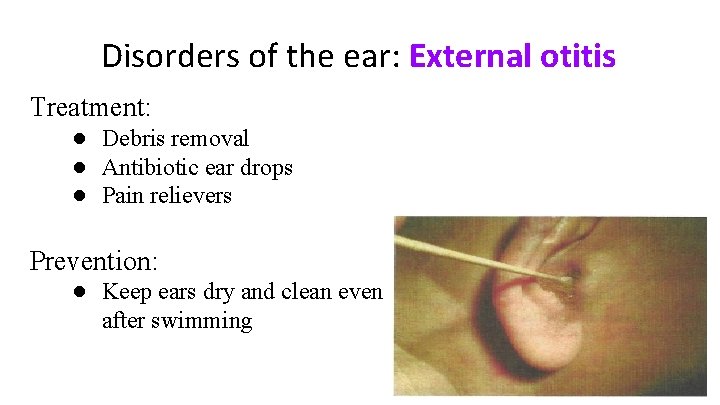 Disorders of the ear: External otitis Treatment: ● Debris removal ● Antibiotic ear drops