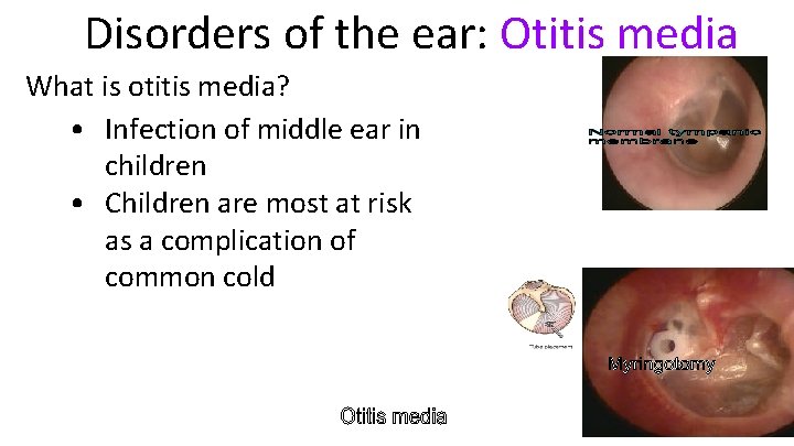 Disorders of the ear: Otitis media What is otitis media? • Infection of middle