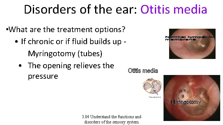 Disorders of the ear: Otitis media • What are the treatment options? • If