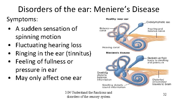 Disorders of the ear: Meniere’s Disease Symptoms: • A sudden sensation of spinning motion