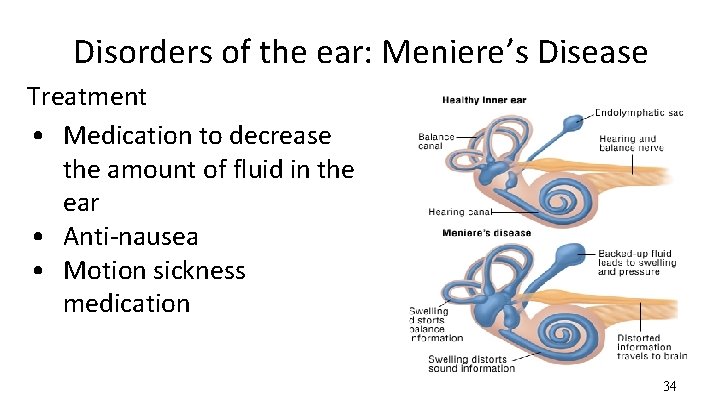 Disorders of the ear: Meniere’s Disease Treatment • Medication to decrease the amount of