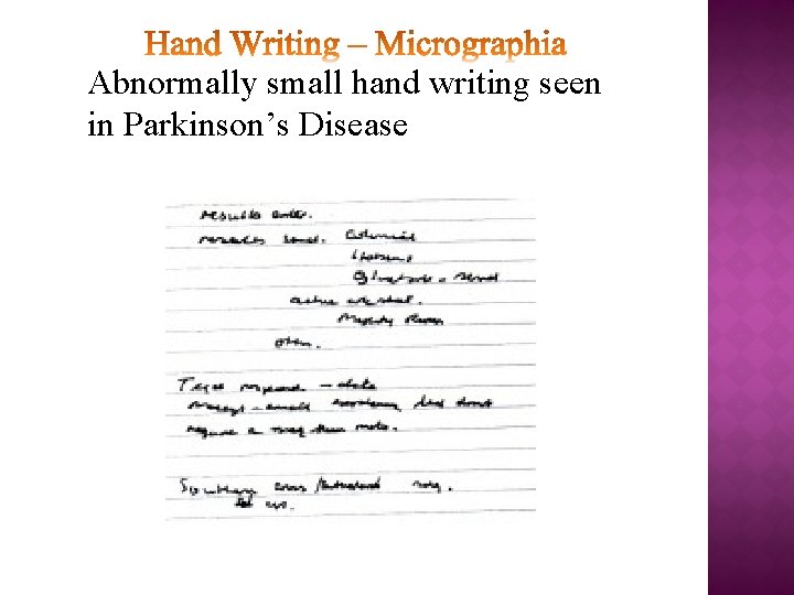 Abnormally small hand writing seen in Parkinson’s Disease 