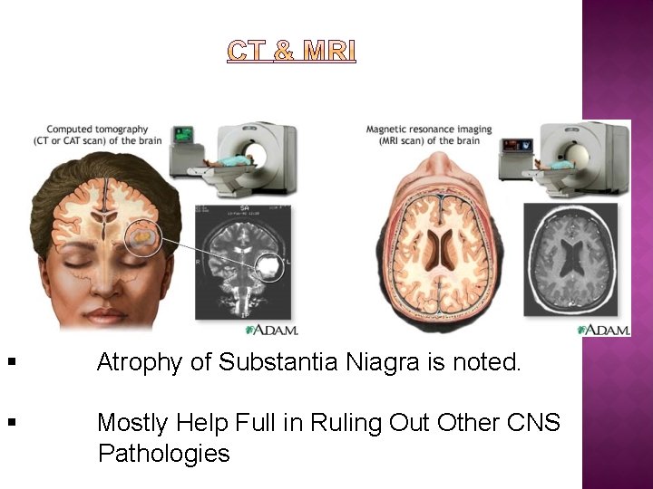 § Atrophy of Substantia Niagra is noted. § Mostly Help Full in Ruling Out