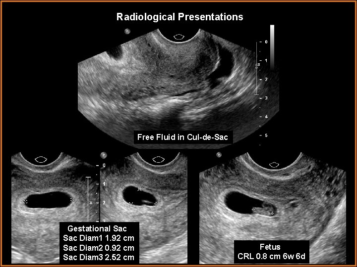 Radiological Presentations Free Fluid in Cul-de-Sac Gestational Sac Diam 1 1. 92 cm Sac