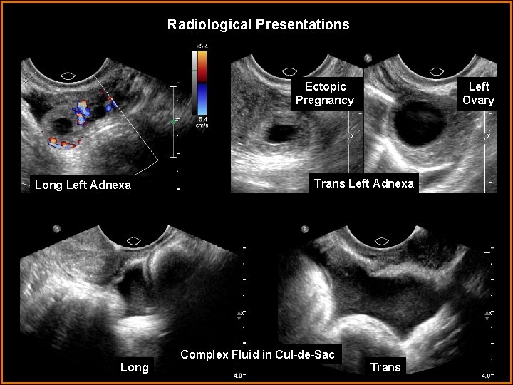 Radiological Presentations Ectopic Pregnancy Long Left Adnexa Left Ovary Trans Left Adnexa Complex Fluid