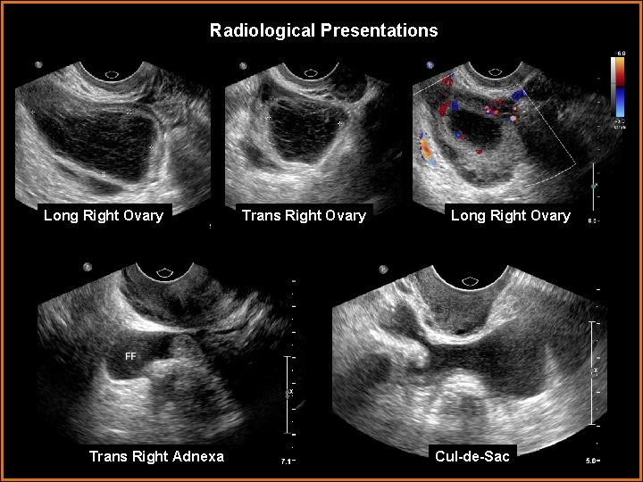 Radiological Presentations Long Right Ovary Trans Right Adnexa Trans Right Ovary Long Right Ovary