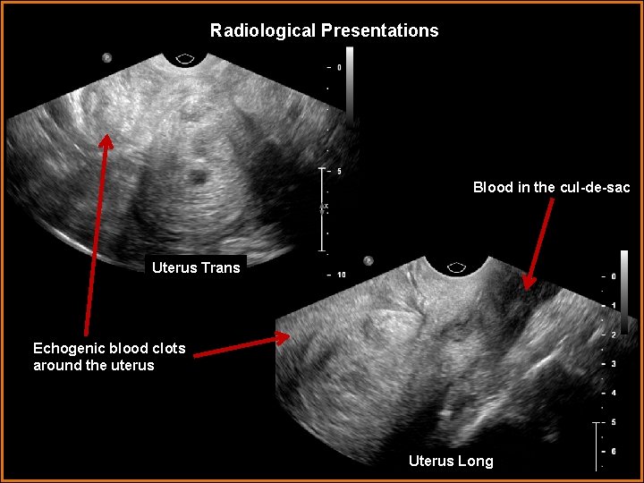 Radiological Presentations Blood in the cul-de-sac Uterus Trans Echogenic blood clots around the uterus