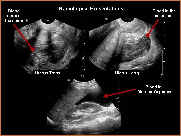 Blood around the uterus Radiological Presentations Uterus Trans Blood in the cul-de-sac Uterus Long