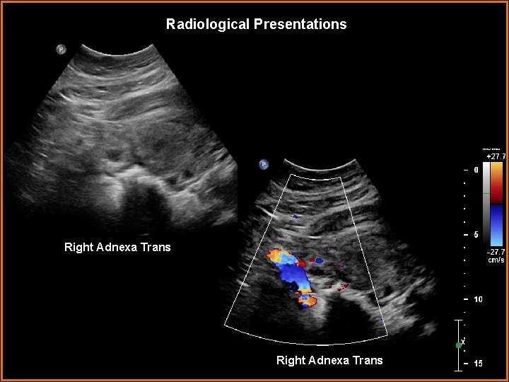 Radiological Presentations Right Adnexa Trans 