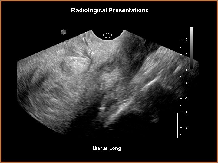 Radiological Presentations Uterus Long 
