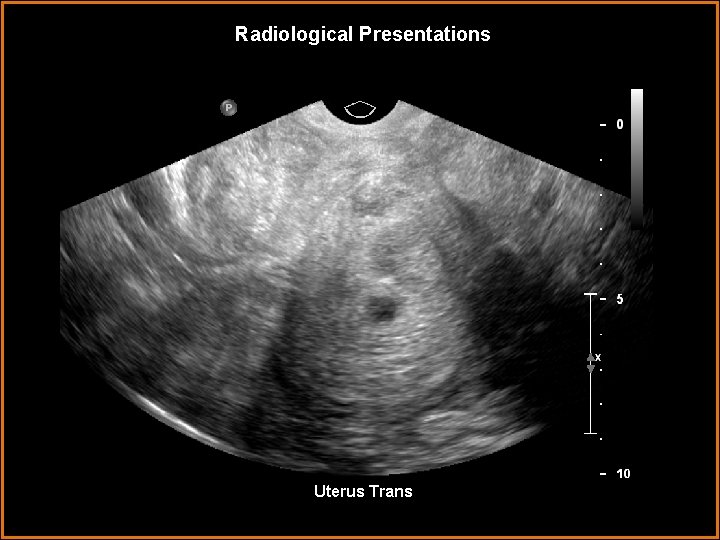 Radiological Presentations Uterus Trans 