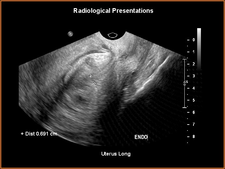 Radiological Presentations + Dist 0. 691 cm Uterus Long 