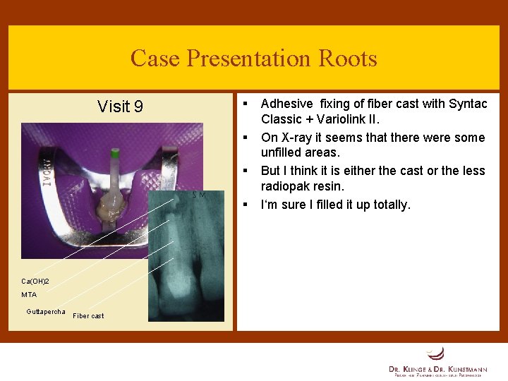 Case Presentation Roots Visit 9 § § Ca(OH)2 MTA Guttapercha Fiber cast Adhesive fixing