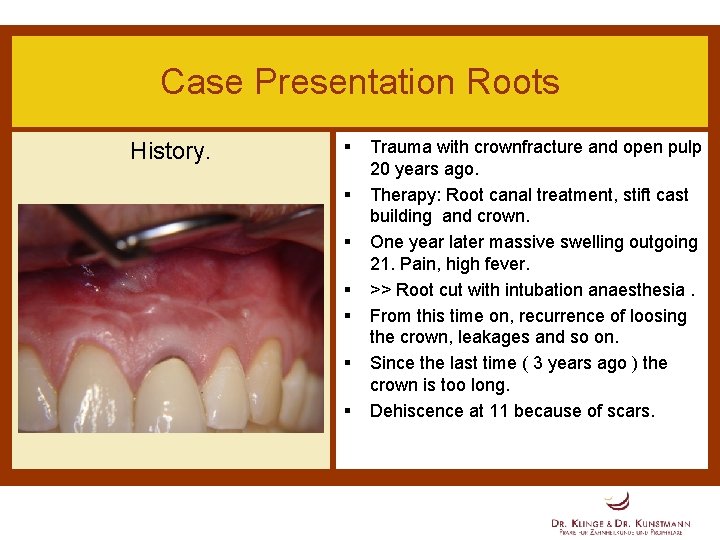 Case Presentation Roots History. § § § § Trauma with crownfracture and open pulp